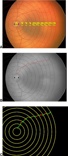 A novel method of quantifying retinal vascular tortuosity in retinopathy of prematurity - Scientific Reports