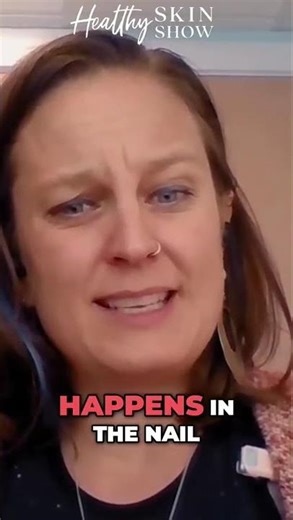 Got THESE Symptoms of Nail Psoriasis 😱 #shorts