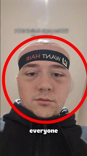 Why Hair Transplant Heads Look HUGE 😭💀 #HairTransplant #Funny #Shorts