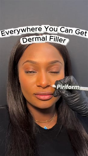 Where Dermal Filler Can Be Placed | Lip, Cheek, Jawline & Facial Balancing Explained