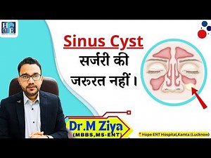 Maxillary sinus cyst. Cyst in the sinuses.