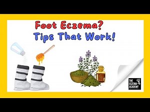 Best Methods For Managing Foot Eczema Symptoms