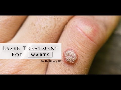 Warts removal with Laser Treatment | Dr. Chiam CT