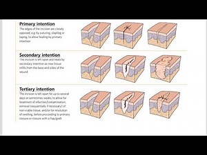 Differences between Primary Intention wound healing and Secondary Intention wound healing