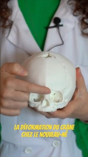 Skull deformation in newborns