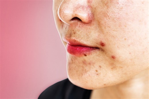 I’ve Had Acne Forever. When I Became a Microbiologist, I Finally Figured Out How to Fix It.