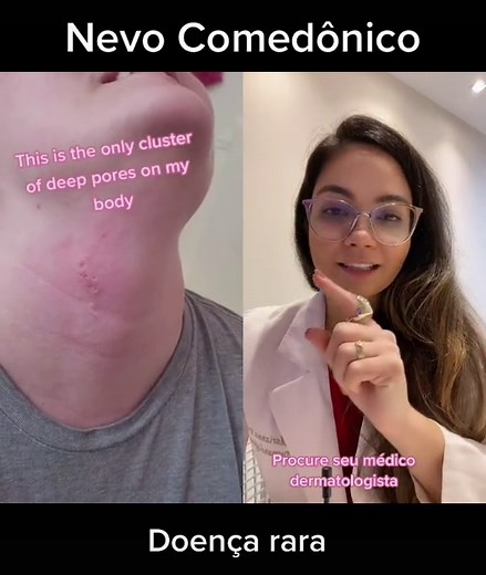 Understanding Nevus Comedonicus: Symptoms, Diagnosis, and Treatment Options