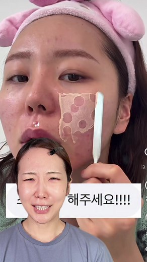 消えるニキビパッチで速攻ケア