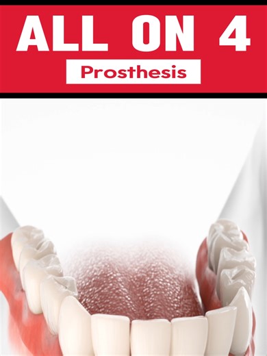 Who is a good candidate for the All-on-4 prosthesis? The All-on-4 prosthesis is a dental implant solution that uses four strategically placed implants to support a full set of teeth. It is a great option for patients who have lost most or all of their teeth, providing a strong and stable foundation for a fixed #dentalbridge #ToothHQ #Dentalimplants #gumtastic #Dentists #Dentistry #Dental #Dentist #allon4 #Oralsurgeon #Oralsurgery #dentalimplant #teeth #teethcare #Smile #fyp #smilemakeover #tooth