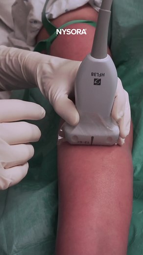 Curious about mastering ultrasound-guided techniques for challenging IV access? In this case, the patient, undergoing surgery on her left arm, had hemiparesis on the right side, making traditional IV placement methods challenging. Watch as one of our experts skillfully uses ultrasound guidance to place an IV line where standard techniques weren’t an option. 👉 Discover more tips and techniques with the NYSORA IV App and Manual—your go-to resource for confident vascular access.