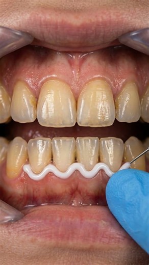 Laser Teeth Whitening Explained 🦷 Dental Animation & Results Overview