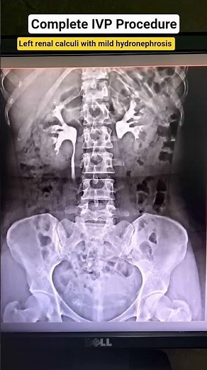 Complete IVP PROCEDURE//Left renal calculi with mild hydronephrosis #IVP #specialstudy #xray