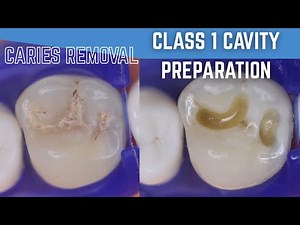 Caries Removal 🔵 Class 1 Cavity Preparation on Maxillary 1st Molar ⚪️