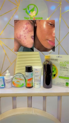 Effective Acne Treatment: The Ultimate Maxi Set