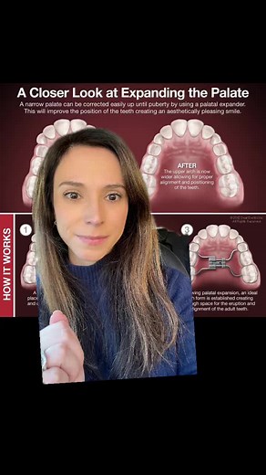#greenscreen isnt orthodontics fun! Orthodontic expanders can help in so many ways. #orthodontist #expander #myofunctionaltherapy #nasalbreathing