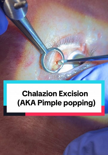 Chalazion Removal: Step-by-Step Guide to Excision