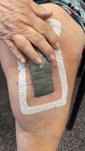 48 hours after knee replacement surgery, pain can still be significant—but you don’t have to suffer through it. . This type of surgical dressing is designed to protect the incision and support healing. The incision itself is secure, but pain levels can vary widely from person to person during the first few days. . If your pain feels severe, uncontrolled, or worse than expected, contact your surgical team. They may be able to adjust your medications, timing, or overall pain management plan. . Bet