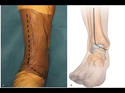 Extensile Antero- Lateral Approach to the Tibia
