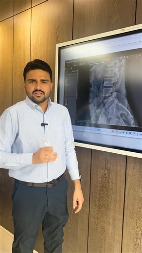 Dr Harish Grover |Chiropractor on Instagram: "After a laminectomy, the spinal bones (lamina) are removed to decompress the nerves — but it can sometimes lead to instability and pars defect, causing severe pain while sitting, standing, or lying down. In this video, I treated a complex post-laminectomy case where the patient had weakness and instability at L4-L5 and L5-S1 levels. Through chiropractic spinal alignment and decompression, the patient experienced instant relief and freedom of movement