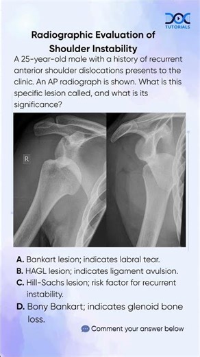 Hill-Sachs Lesion in Recurrent Shoulder Instability|Radiographic Evaluation for Orthopedic Residents