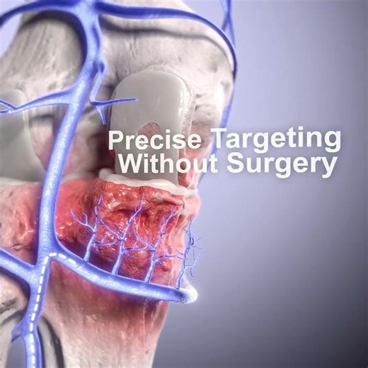 Genicular Artery Embolization (GAE) Animation