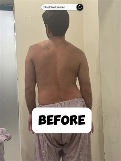 A lateral pelvic shift, also known as lateral pelvic tilt, is a movement or position where the pelvis moves or is positioned laterally (sideways) to one side. #physiotherapy #physio #lahore #fyp