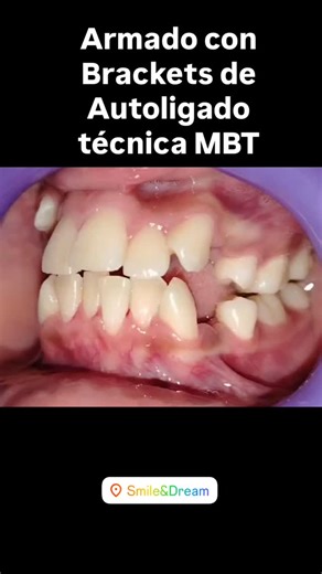 ✨ Armado de brackets de autoligado – Técnica MBT ✨ Mira el cambio del mismo día: así colocamos los brackets y dejamos todo listo para iniciar la transformación. ✔️ Técnica MBT para un tratamiento más eficiente Comienza el camino hacia una sonrisa increíble.  Quintana Roo 509-A, Col. Francisco Murguía, Toluca, México  722 2256944 #SmileAndDream #Ortodoncia #Autoligado #TecnicaMBT #Brackets #Toluca #Odontología | Smile&Dream | Facebook