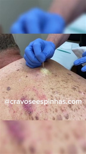 #pimplepop #pimplepopin #pimplepopin follow for more