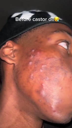 The Ultimate Guide to Clear Skin with Castor Oil