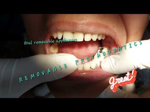 Simultaneous bilateral static and dynamic occlusal harmony, flexible removable partial denture