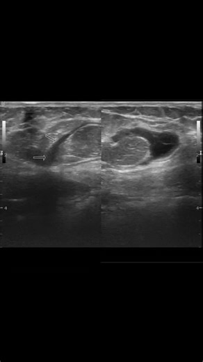 Radiology @all abnormalities 🥏🥏 on Instagram: "Ultrasound Abdominal Wall Report (With Definition) Patient Details Age: 35 years Gender: Female Clinical Presentation: Pain in the epigastric region for 1 week Technique High-frequency linear transducer ultrasound examination of the anterior abdominal wall, with focused assessment of the epigastric region. Findings A midline anterior abdominal wall defect is noted in the epigastric region. The defect shows herniation of omental fat along with a sm