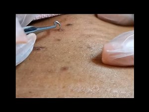 Those Stuck hairs🤤 Ingrowns Removal!