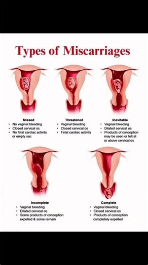 Pregnancy Loss Explained 💔 | Types of Miscarriage #anatomy #pregnancy #miscarriage #shorts #reels