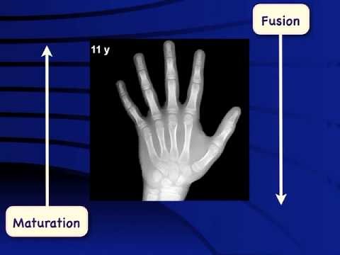 Bone age assessment