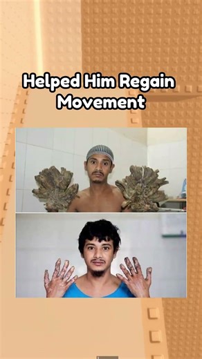 People with rare genetic disorders #shorts #robloxrant #roblox