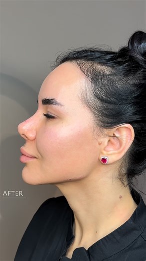 Fatima Gadzhimuradova on Instagram: "CLARPENING AND YOUTHFULNESS😍🔥 One of my favorite parts of the procedure is seeing how the facial balance changes. By adding volume in the right areas, we emphasized the cheekbones, shaped the chin and defined the lower third, and also performed a subtle correction of the nose. ✔️Result: The face looks slimmer and younger."