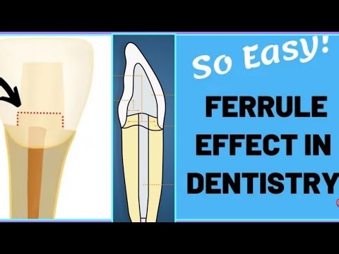 Ferrule Effect In Dentistry Explained And Simplified | Crown Success After RCT|