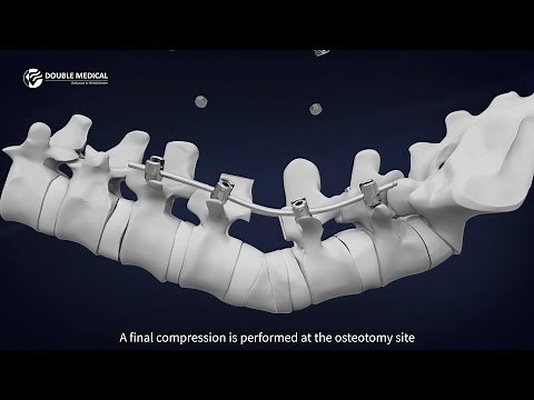Pedicle Subtraction Osteotomy (PSO) Procedure with Double Medical PSO Instrument Set