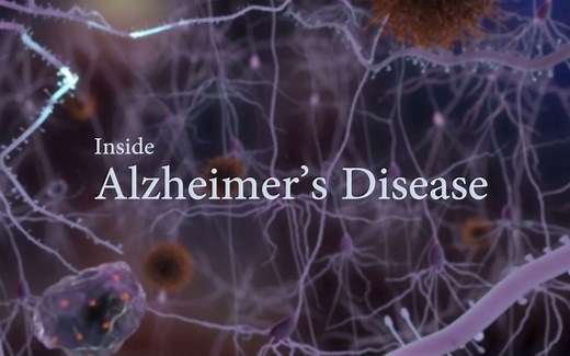[英文字幕] 阿尔兹海默症简介 Inside Alzheimer's disease
