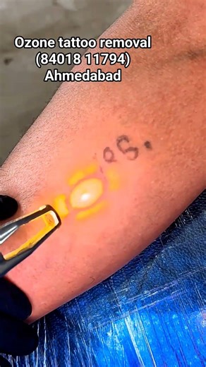 laser tattoo removal first session, how to remove tattoo, #lasertattooremoval #tattooremoval