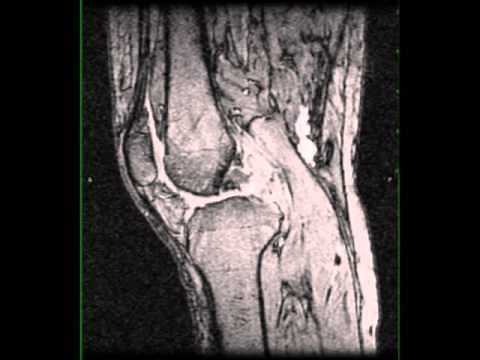 Pigmented Villonodular Synovitis, Knee
