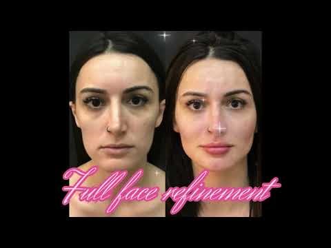 Full face refinement 