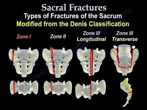 Sacral Fractures - Everything You Need To Know  • Video • MEDtube.net