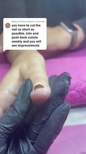 Psoriasis Nail Treatment and Care: Understanding the Symptoms