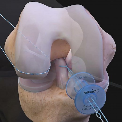 ACLtear.com - Arthrex ACL Repair