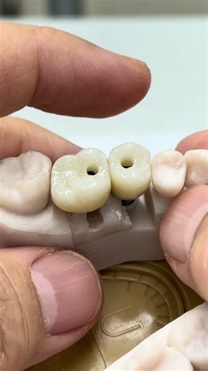 Tall abutments for implant crown!