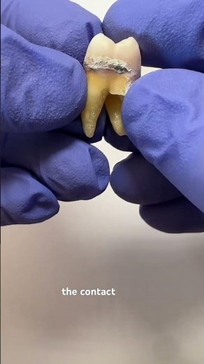 Let’s look at a tooth with calculus. What tooth number is this? #dentistry #dentist #dentalhygienist