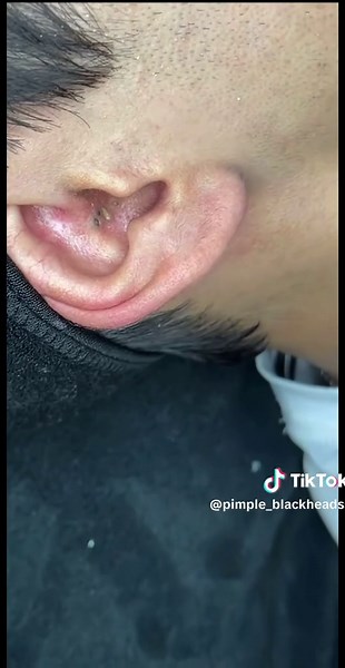 #pimple #blackhead #fyp #viral