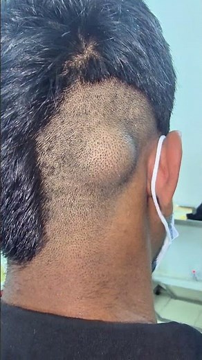 Epidermal Inclusion Cyst