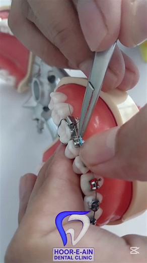 How To Tie O-ring #timelapse #journey #how #how #shortsfeed #shorts #trendingshorts #views #braces